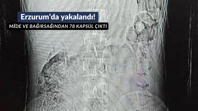 Mide ve bağırsağından 78 kapsül çıktı
