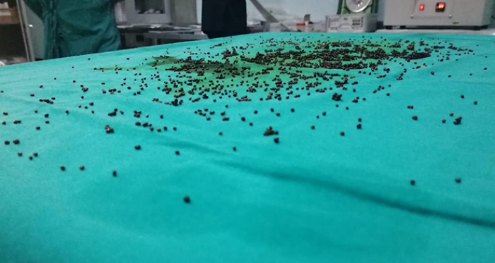 Safra kesesinden 3 bin 765 taş çıkarıldı